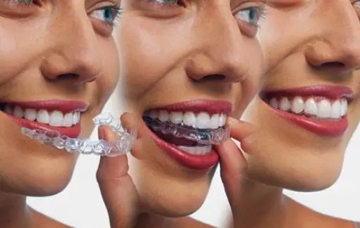 Three phases of person putting aligners in